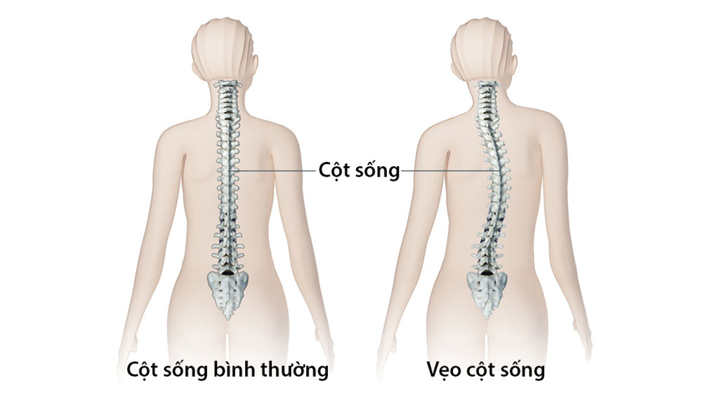 Vẹo cột sống