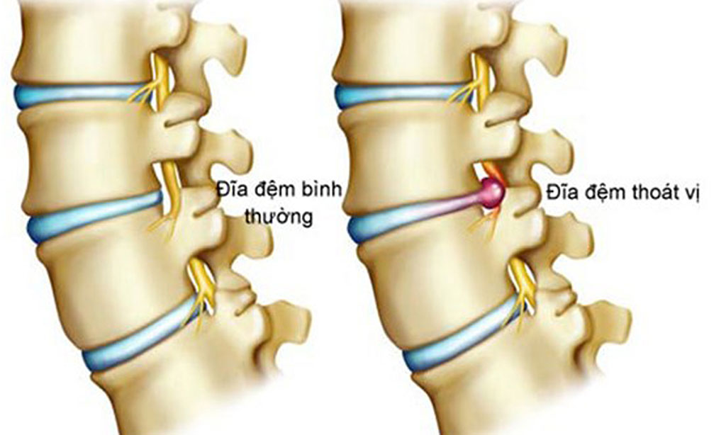 Bệnh thoát vị đĩa đệm